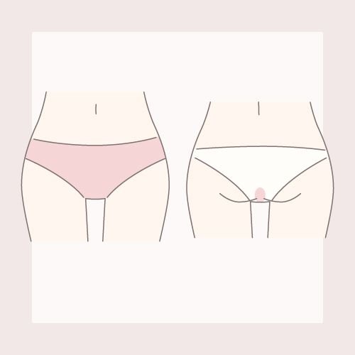 VIOセット脱毛